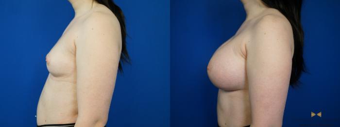 Before & After Breast Augmentation Case 229 View #5 View in Fort Worth & Arlington, Texas
