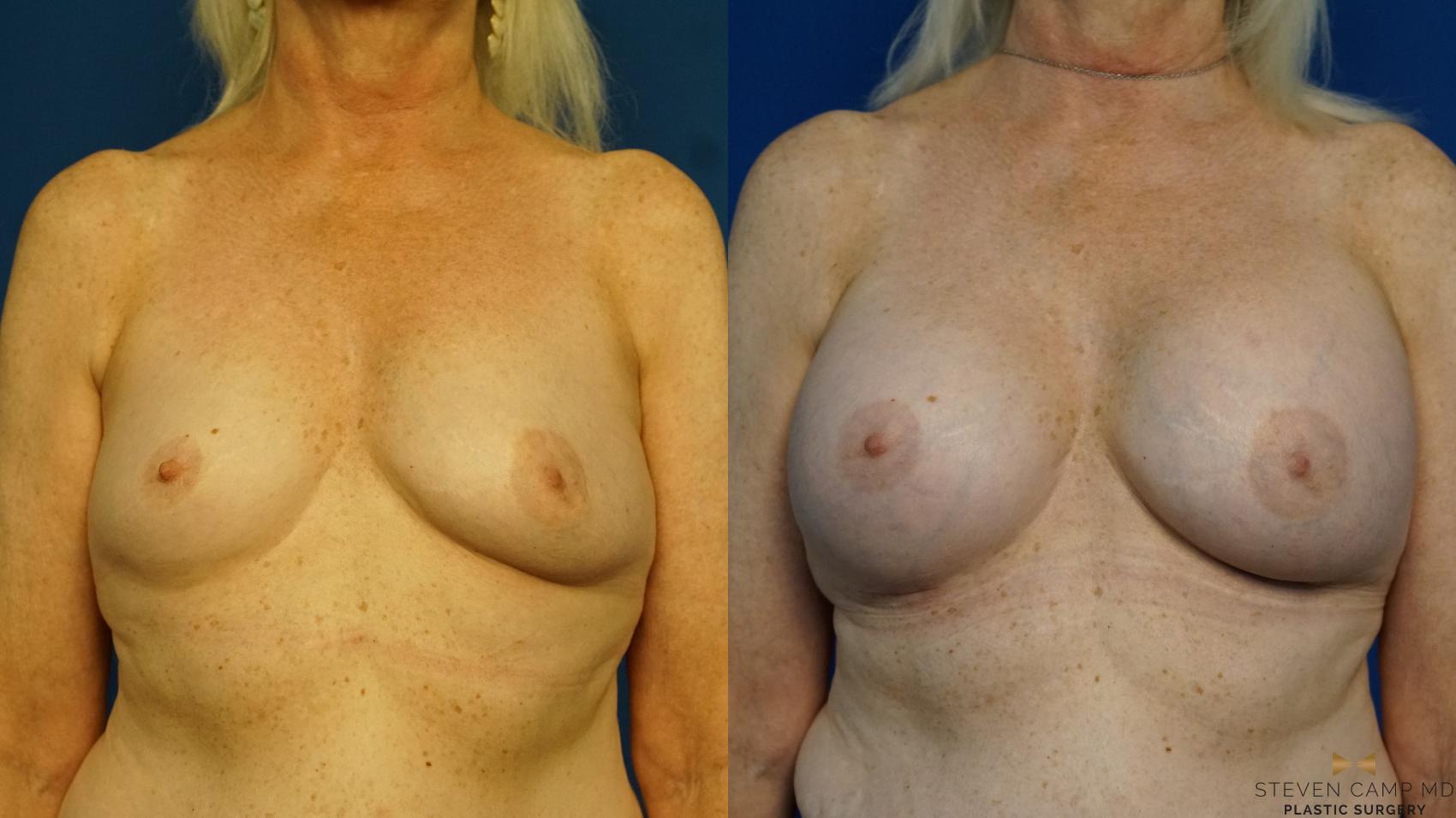 Before & After Breast Augmentation Case 232 View #1 View in Fort Worth & Arlington, Texas