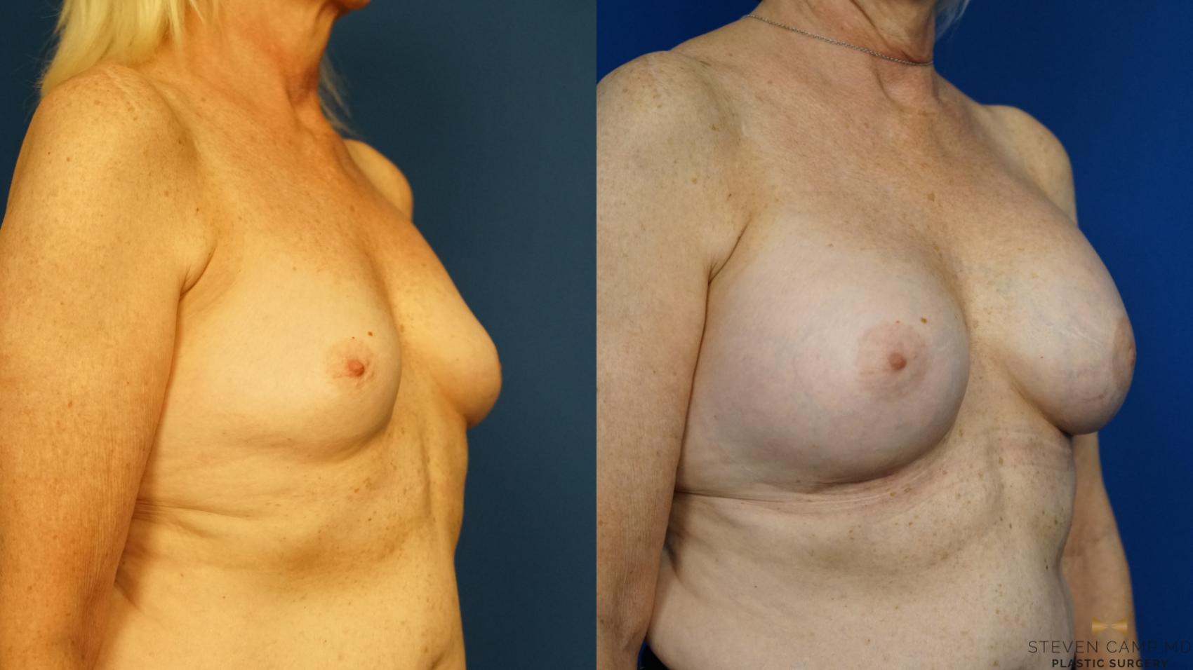 Before & After Breast Augmentation Case 232 View #2 View in Fort Worth & Arlington, Texas