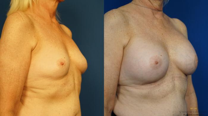 Before & After Breast Augmentation Case 232 View #2 View in Fort Worth & Arlington, Texas