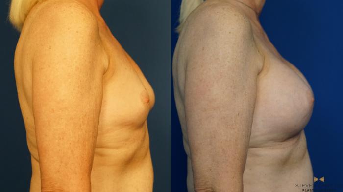 Before & After Breast Augmentation Case 232 View #3 View in Fort Worth & Arlington, Texas