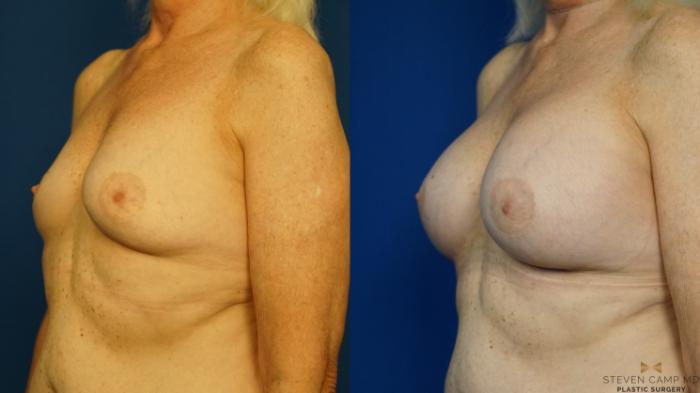 Before & After Breast Augmentation Case 232 View #4 View in Fort Worth & Arlington, Texas