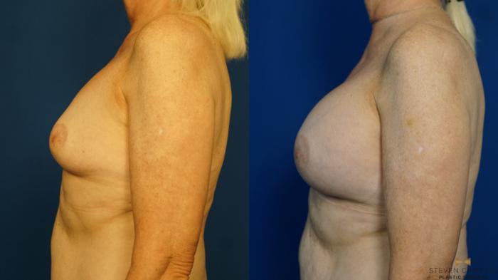 Before & After Breast Augmentation Case 232 View #5 View in Fort Worth & Arlington, Texas