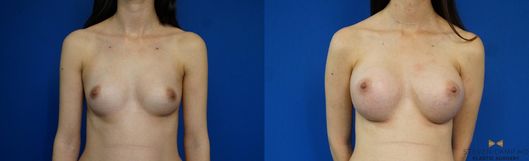 Before & After Breast Augmentation Case 233 View #1 View in Fort Worth & Arlington, Texas