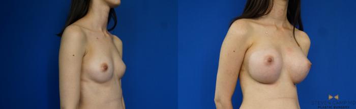 Before & After Breast Augmentation Case 233 View #2 View in Fort Worth & Arlington, Texas