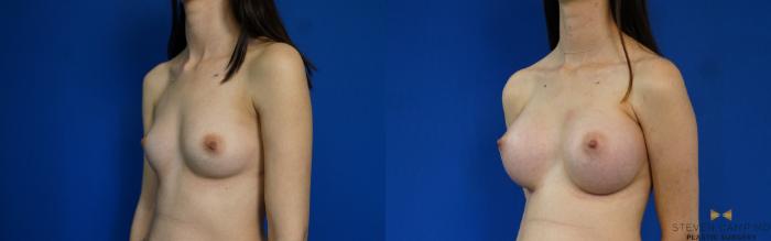 Before & After Breast Augmentation Case 233 View #4 View in Fort Worth & Arlington, Texas