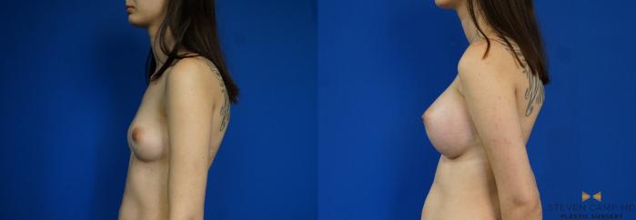 Before & After Breast Augmentation Case 233 View #5 View in Fort Worth & Arlington, Texas