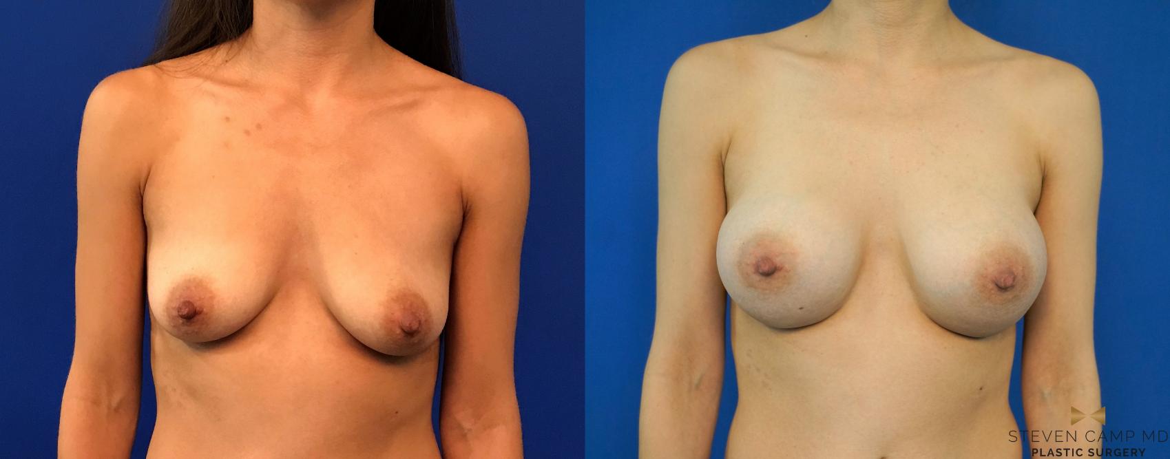 Before & After Breast Augmentation Case 235 View #1 View in Fort Worth, Texas