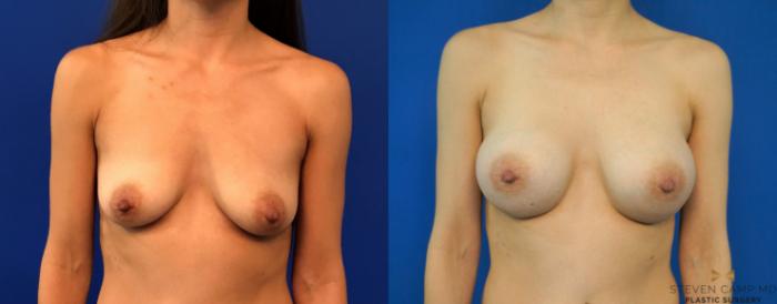 Before & After Breast Augmentation Case 235 View #1 View in Fort Worth & Arlington, Texas