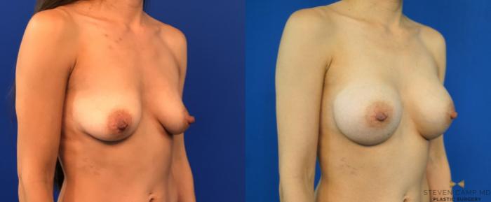 Before & After Breast Augmentation Case 235 View #2 View in Fort Worth, Texas