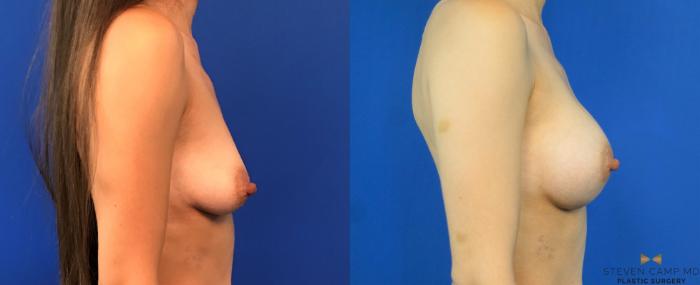 Before & After Breast Augmentation Case 235 View #3 View in Fort Worth, Texas