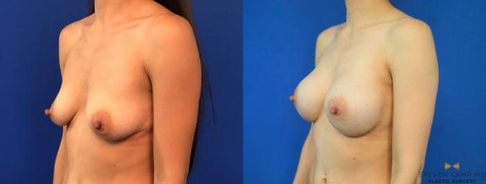Before & After Breast Augmentation Case 235 View #4 View in Fort Worth, Texas