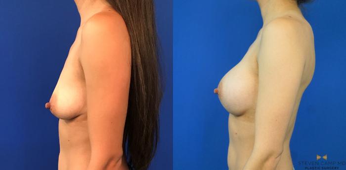 Before & After Breast Augmentation Case 235 View #5 View in Fort Worth & Arlington, Texas