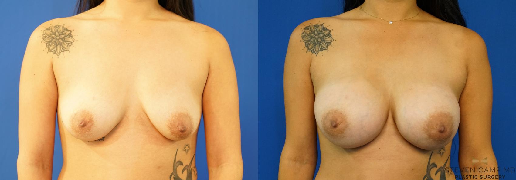 Before & After Breast Augmentation Case 236 View #1 View in Fort Worth & Arlington, Texas