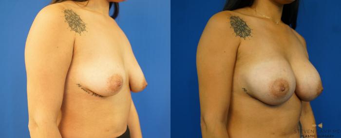 Before & After Breast Augmentation Case 236 View #2 View in Fort Worth & Arlington, Texas