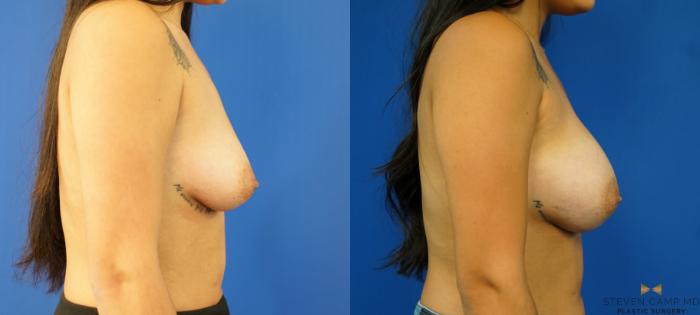 Before & After Breast Augmentation Case 236 View #3 View in Fort Worth & Arlington, Texas