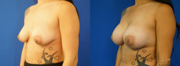 Before & After Breast Augmentation Case 236 View #4 View in Fort Worth & Arlington, Texas