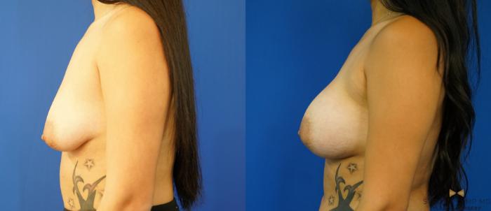 Before & After Breast Augmentation Case 236 View #5 View in Fort Worth & Arlington, Texas
