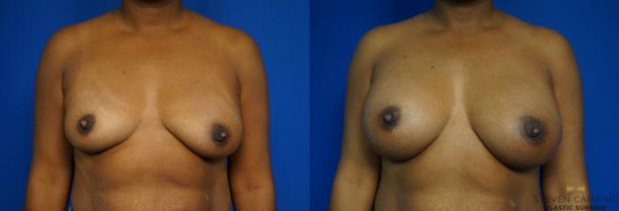 Before & After Breast Augmentation Case 239 View #1 View in Fort Worth & Arlington, Texas