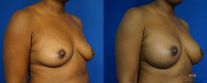 Before & After Breast Augmentation Case 239 View #2 View in Fort Worth, Texas