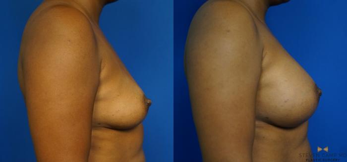 Before & After Breast Augmentation Case 239 View #3 View in Fort Worth & Arlington, Texas