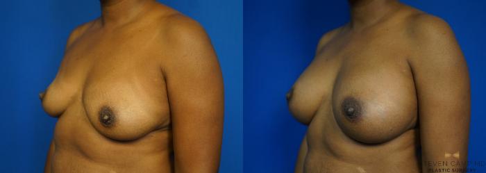 Before & After Breast Augmentation Case 239 View #4 View in Fort Worth, Texas