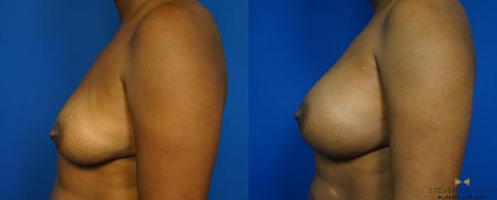 Before & After Breast Augmentation Case 239 View #5 View in Fort Worth & Arlington, Texas