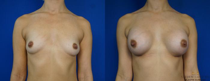 Before & After Breast Augmentation Case 241 View #1 View in Fort Worth & Arlington, Texas
