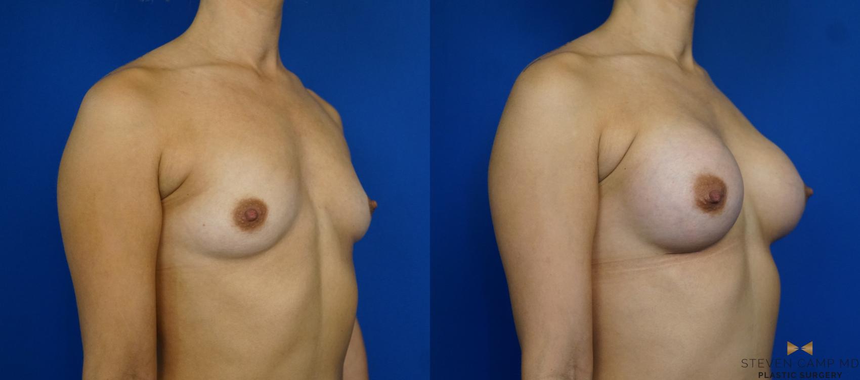 Before & After Breast Augmentation Case 241 View #2 View in Fort Worth & Arlington, Texas