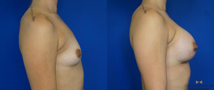 Before & After Breast Augmentation Case 241 View #3 View in Fort Worth & Arlington, Texas