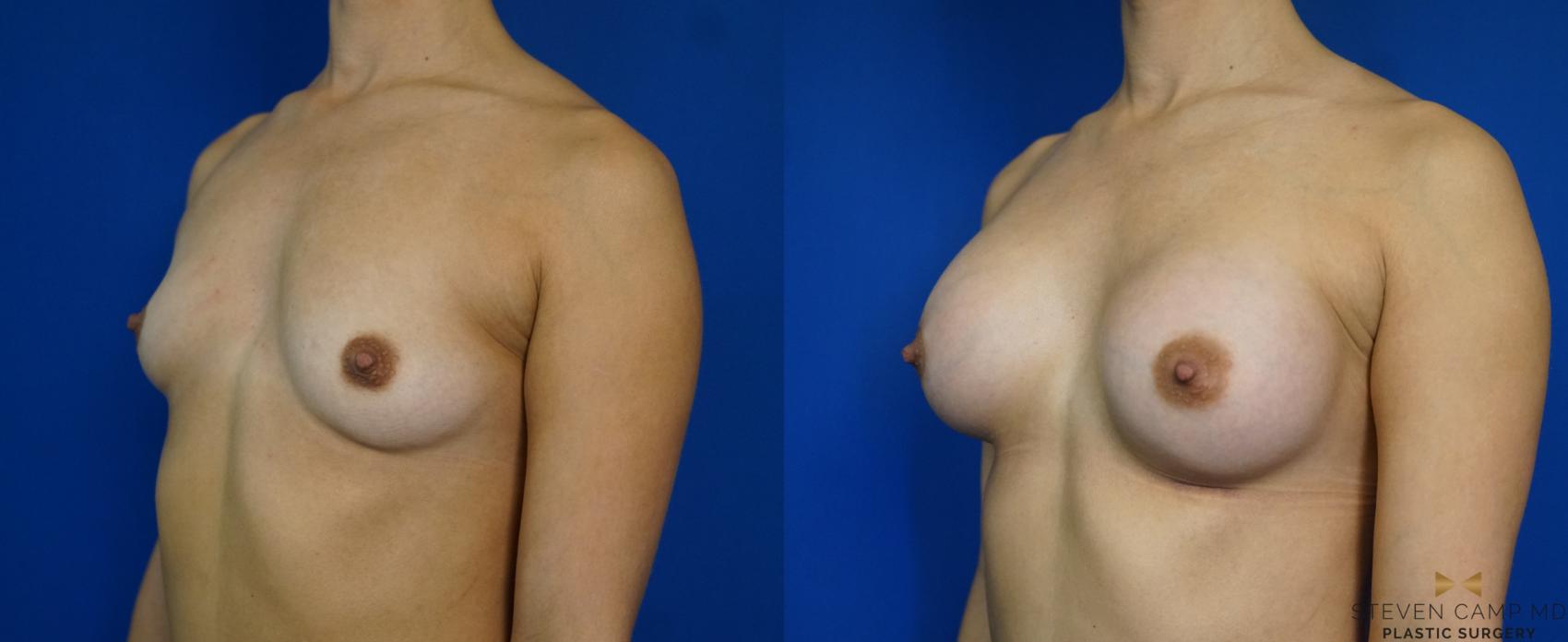 Before & After Breast Augmentation Case 241 View #4 View in Fort Worth & Arlington, Texas