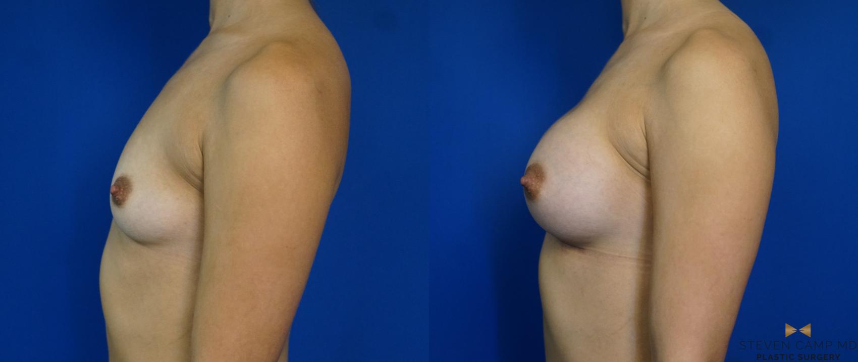Before & After Breast Augmentation Case 241 View #5 View in Fort Worth & Arlington, Texas