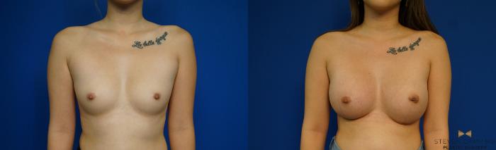 Before & After Breast Augmentation Case 243 View #1 View in Fort Worth & Arlington, Texas