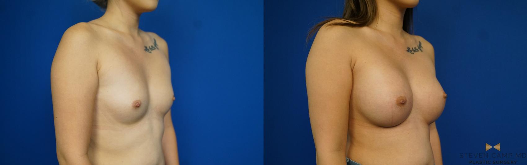 Before & After Breast Augmentation Case 243 View #2 View in Fort Worth & Arlington, Texas