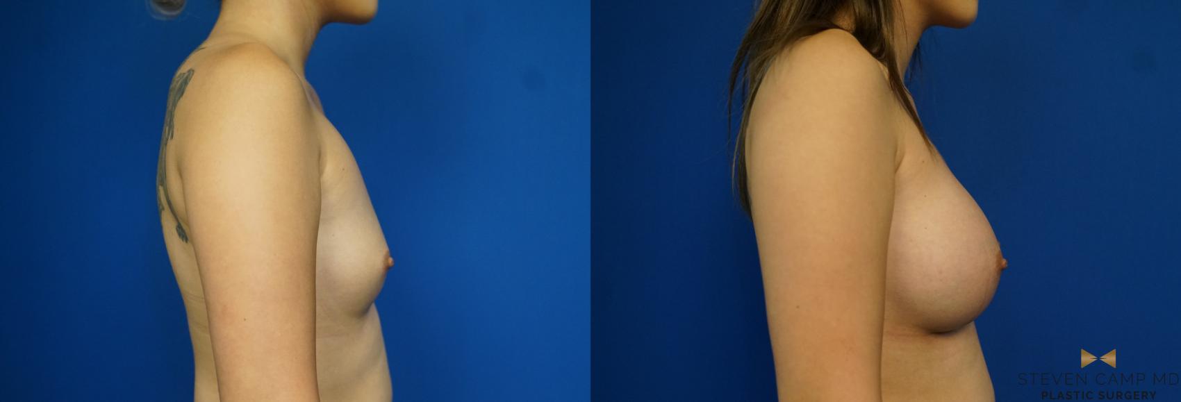 Before & After Breast Augmentation Case 243 View #3 View in Fort Worth & Arlington, Texas
