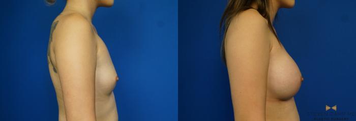 Before & After Breast Augmentation Case 243 View #3 View in Fort Worth & Arlington, Texas