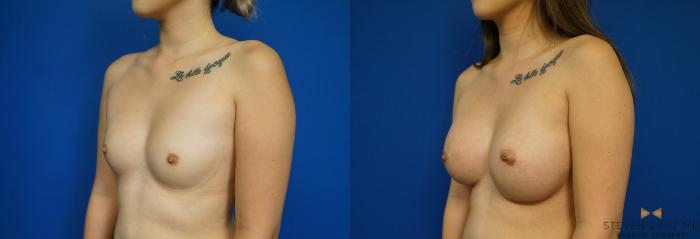 Before & After Breast Augmentation Case 243 View #4 View in Fort Worth & Arlington, Texas