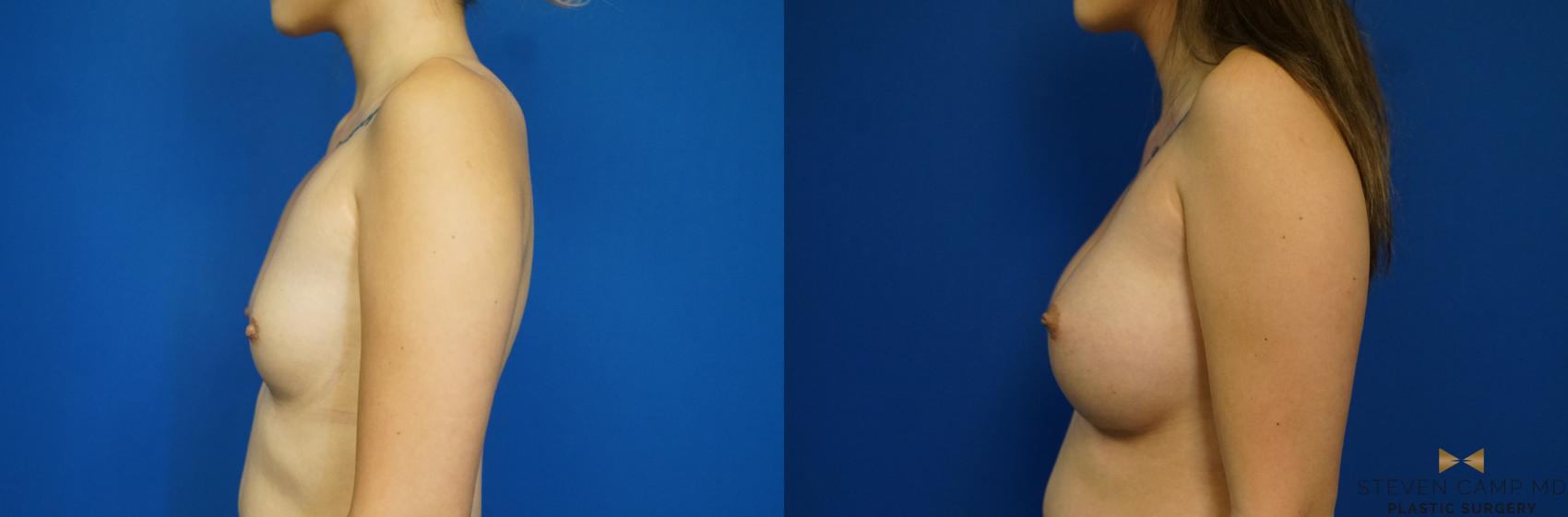 Before & After Breast Augmentation Case 243 View #5 View in Fort Worth & Arlington, Texas