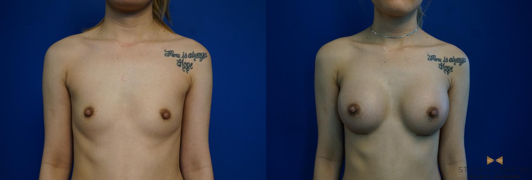 Before & After Breast Augmentation Case 245 View #1 View in Fort Worth & Arlington, Texas