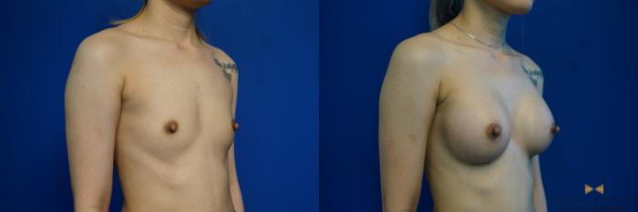 Before & After Breast Augmentation Case 245 View #2 View in Fort Worth & Arlington, Texas