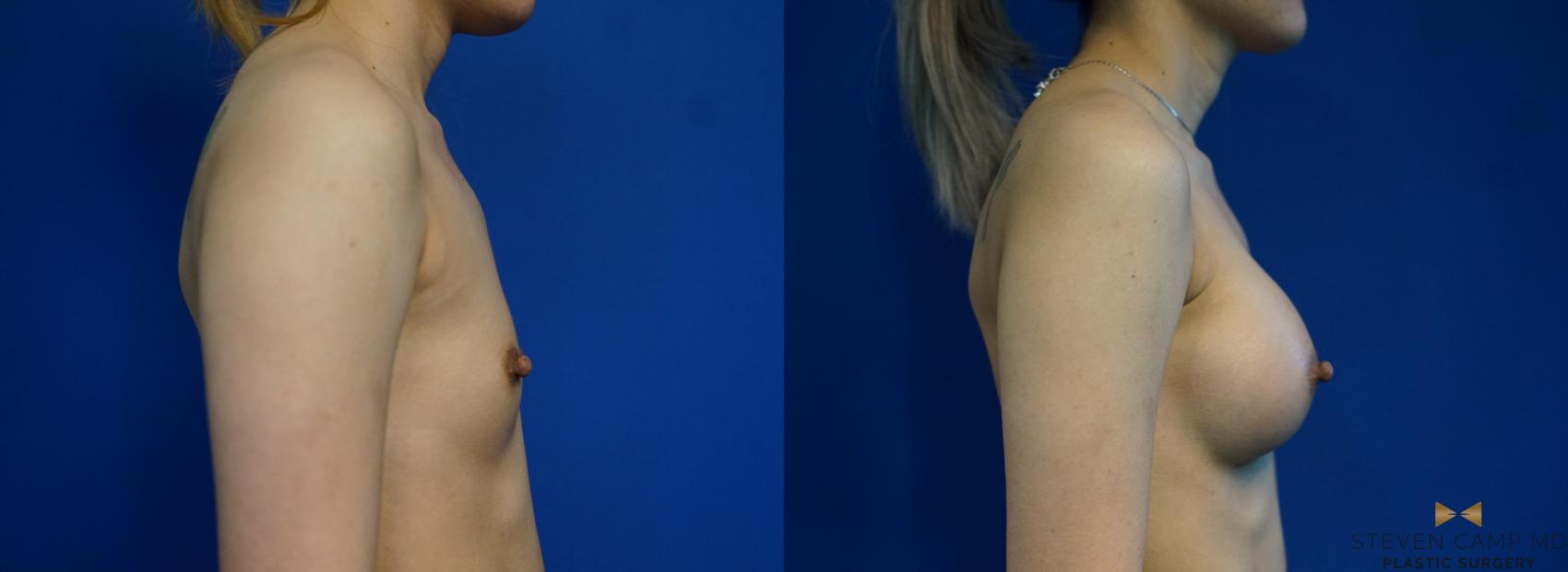 Before & After Breast Augmentation Case 245 View #3 View in Fort Worth & Arlington, Texas