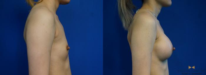 Before & After Breast Augmentation Case 245 View #3 View in Fort Worth & Arlington, Texas
