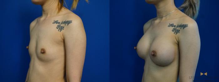 Before & After Breast Augmentation Case 245 View #4 View in Fort Worth & Arlington, Texas