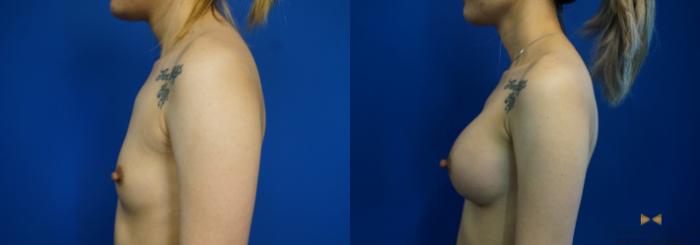 Before & After Breast Augmentation Case 245 View #5 View in Fort Worth & Arlington, Texas