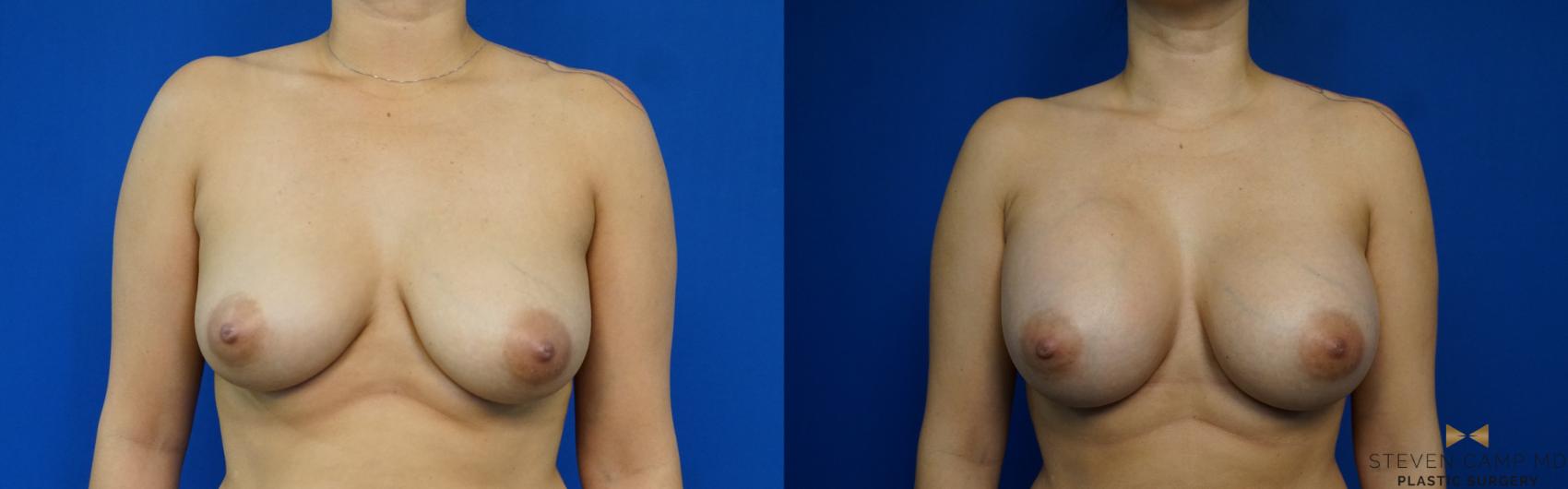 Before & After Breast Augmentation Case 249 View #1 View in Fort Worth & Arlington, Texas