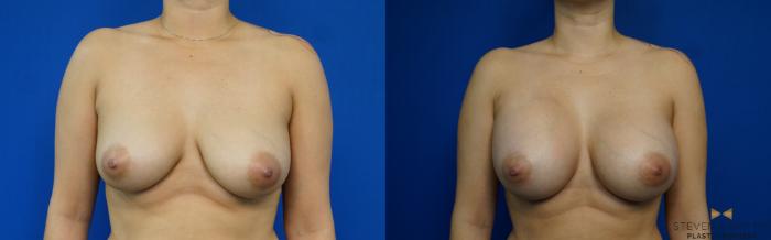 Before & After Breast Augmentation Case 249 View #1 View in Fort Worth & Arlington, Texas