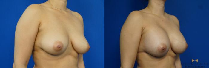 Before & After Breast Augmentation Case 249 View #2 View in Fort Worth & Arlington, Texas