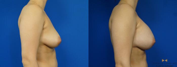 Before & After Breast Augmentation Case 249 View #3 View in Fort Worth & Arlington, Texas