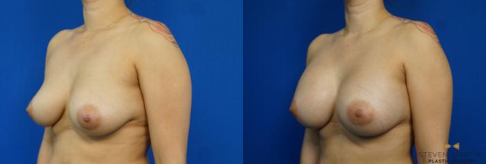 Before & After Breast Augmentation Case 249 View #4 View in Fort Worth & Arlington, Texas