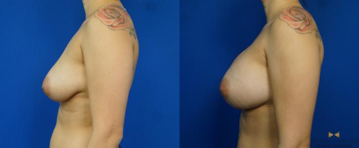 Before & After Breast Augmentation Case 249 View #5 View in Fort Worth & Arlington, Texas